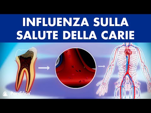 Video: Sintomi Di Infezione Del Dente Che Si Diffondono Al Corpo