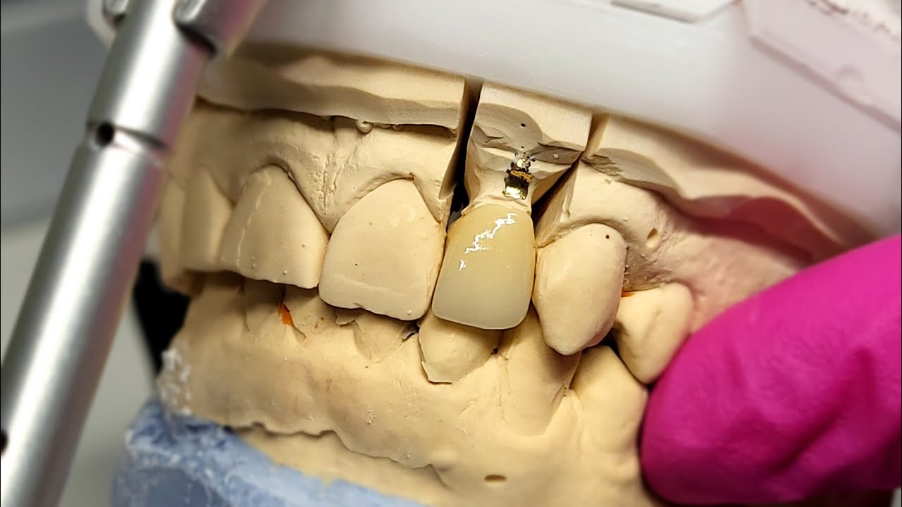 ASMR Glaze and Stain / Zirconia / Full Contur Crown YouTube