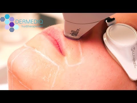 Video: Laserbehandeling Voor Haargroei - Topklinieken In India