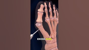 How Bunionectomy Surgery Is Performed? (3D Animation) #3dmedicalanimation #anatomy