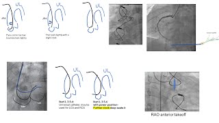 Right coronary engagement: detailed steps, troubleshooting, cases- Amplatz L manipulation-RCA guides