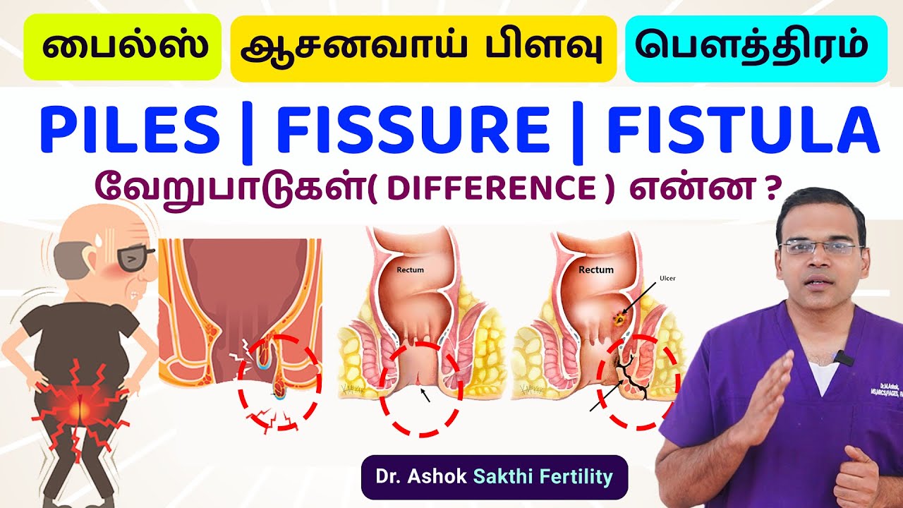 Difference Between Piles Fissure Fistula (பைல்ஸ்,பிளவு மற்றும் பௌத்திரம்) மூலநோய்