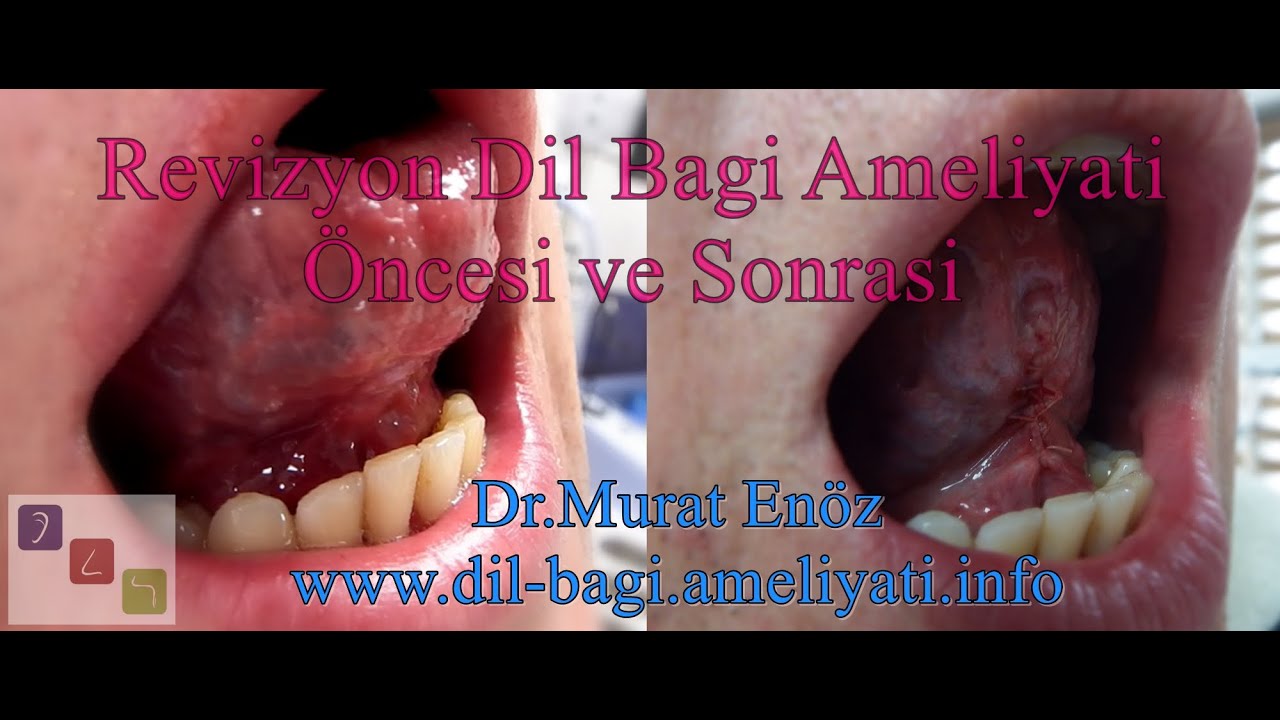 Revizyon Dil Bağı Ameliyatı Öncesi ve Sonrası YouTube