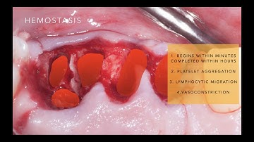 CE Webinar: Ridge Preservation Principles and Materials