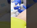 Broad band light for hair reduction at the best medical spa in San Antonio, located in the RIM!