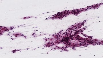 AI-Powered Pathology: ChatGPT Assists Neuropathology Frozen Section with Nature Documentary Twist