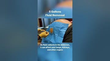 5 Gallons Drained From Abdomen - 40lbs of Fluid #shorts