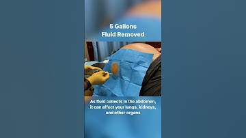 5 Gallons Drained From Abdomen - 40lbs of Fluid #shorts