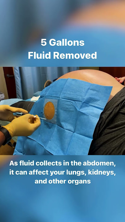 5 Gallons Drained From Abdomen - 40lbs of Fluid #shorts