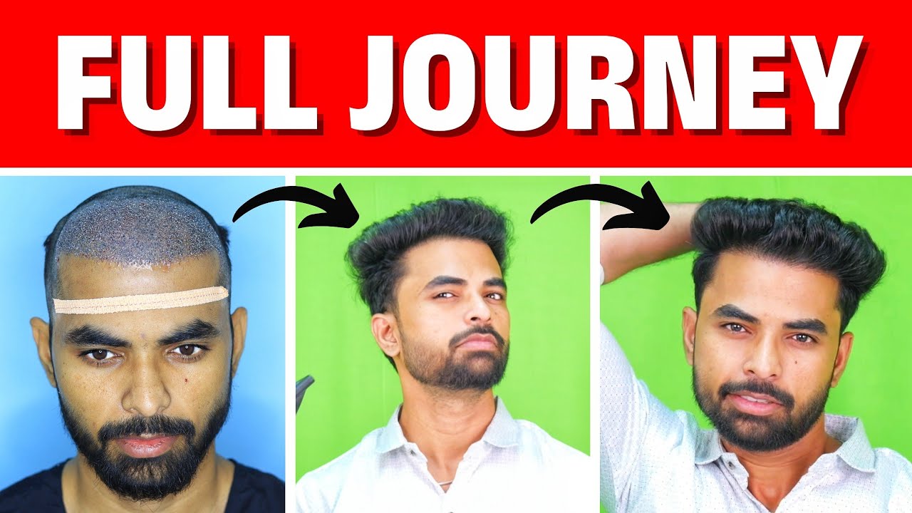 Day 1 to Day 180 : My Hair Transplant Journey In 10 Minutes 🔥🔥🔥