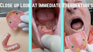 Close up look at upper and lower immediate snap-in overdentures screenshot 4