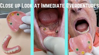 Close up look at upper and lower immediate snap-in overdentures