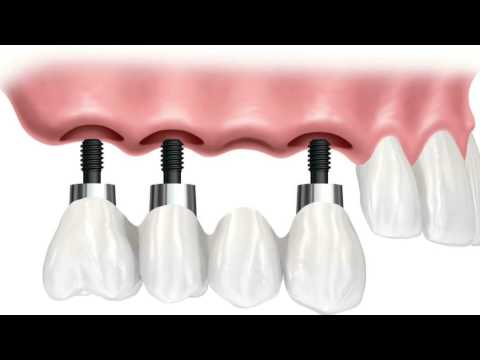 Implants to replace a few teeth? | Daniel Daniel Dentistry
