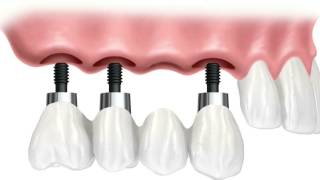 Implants to replace a few teeth? | Daniel Daniel Dentistry