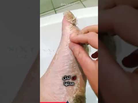 لماذا يتقشر جلد الإنسان اكتشف السبب وكيف تحمي نفسك