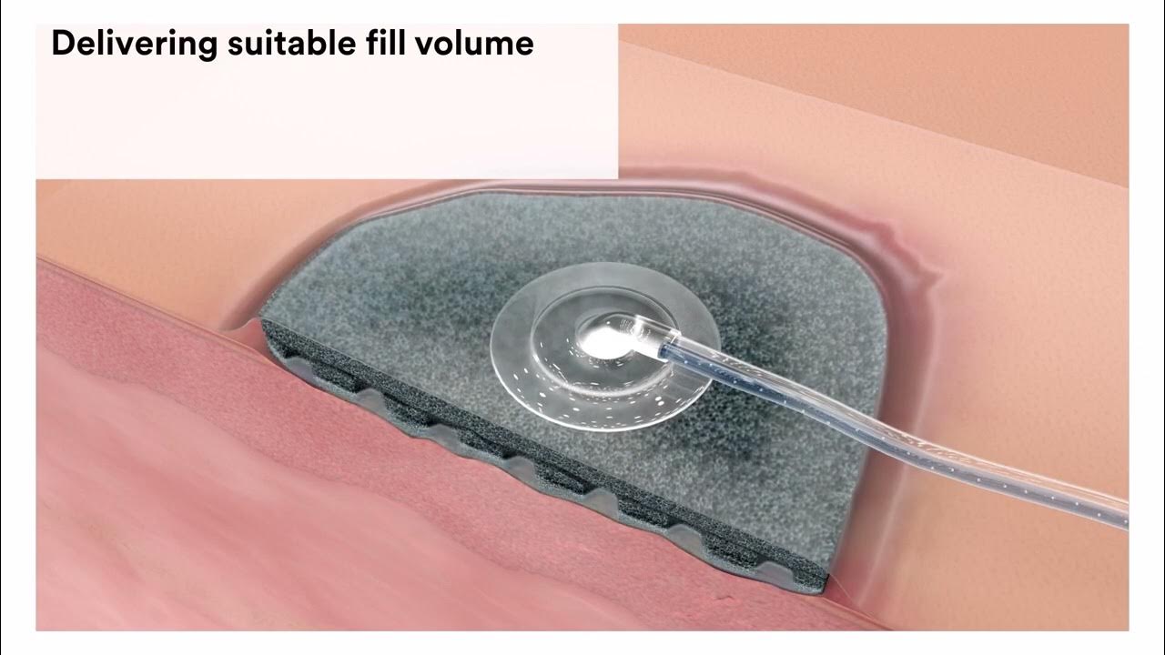 how-to-use-3m-v-a-c-ulta-4-therapy-system-youtube