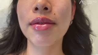Check Out This Subtle Yet Amazing Lip Transformation By Ageless Md