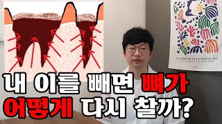 내 이를 빼면 뼈가 어떻게 다시 찰까? 뼈가 녹아서 이를 빼면 얼마나 찰까? (How do my bones repopulate after my teeth are removed?)