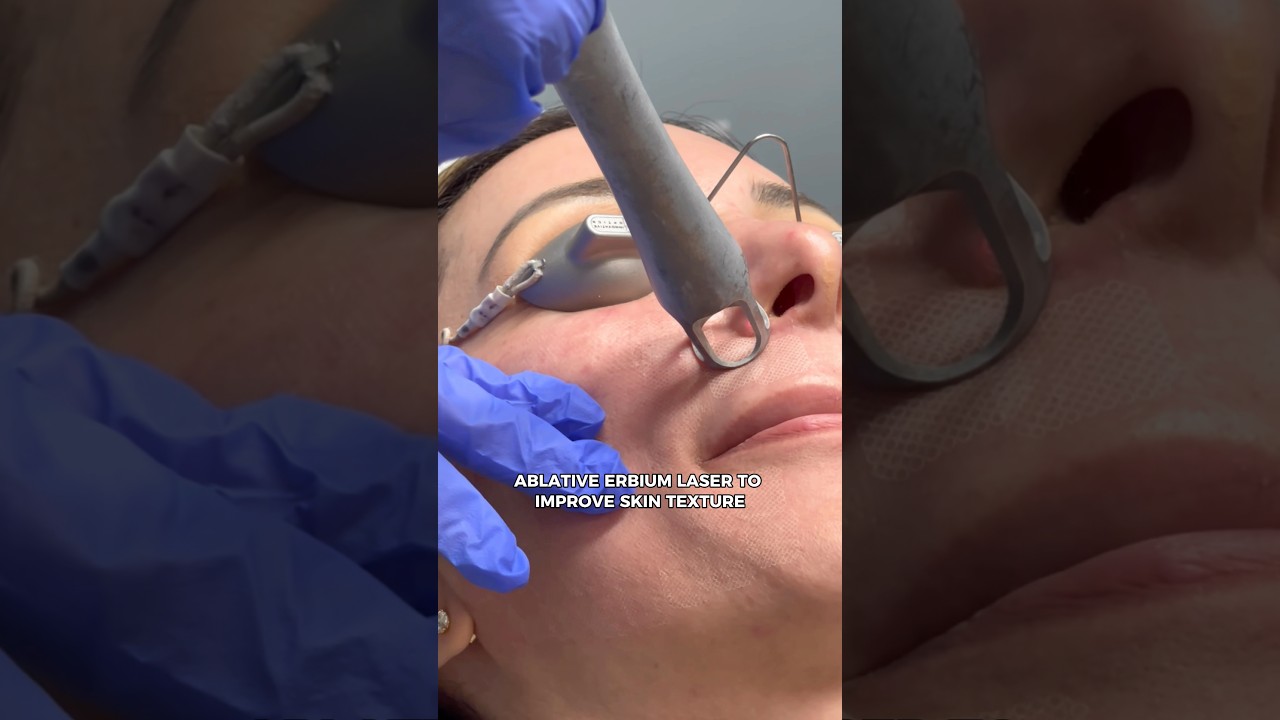 Banner for UltraClear Laser in San Diego | Cold Ablative Laser #ultraclear #laserskinresurfacing