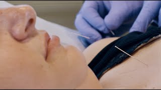 How Does ACUPUNCTURE Work? [Acupuncture Treatment For Back Pain, Headaches & More]