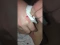 Huge Cyst Explosion and Drainage