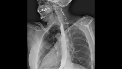 Dynamic X-Ray Retrospective View of the Esophagus in Motion | Konica Minolta Healthcare #cxr