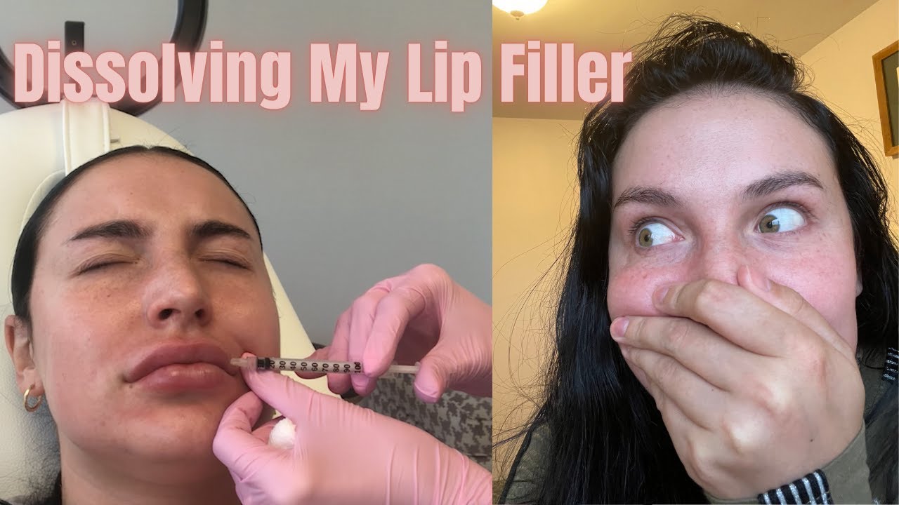 Dissolving Lip Fillers (Before and after with hyaluronidase) Vlog pt. 1 ...