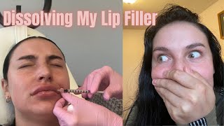 Dissolving Lip Fillers (Before and after with hyaluronidase) Vlog pt. 1