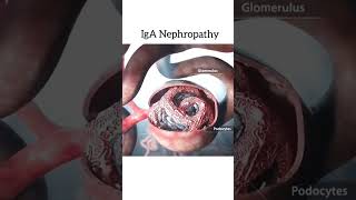IgA nephropathy #IgANephropathy #KidneyDiseaseAwareness #ChronicKidneyDisease #RenalHealth #nephrone