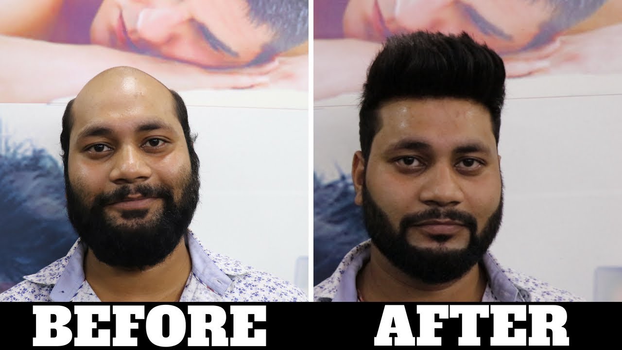 BEFORE & AFTER indias Best hair fixing center, A non surgical hair fixing  system for men in DELHI - YouTube