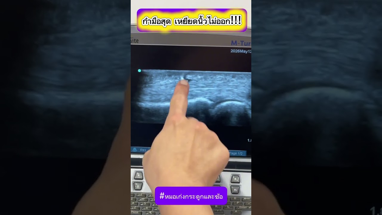 กำมือสุด เหยียดนิ้วไม่ออก !!
