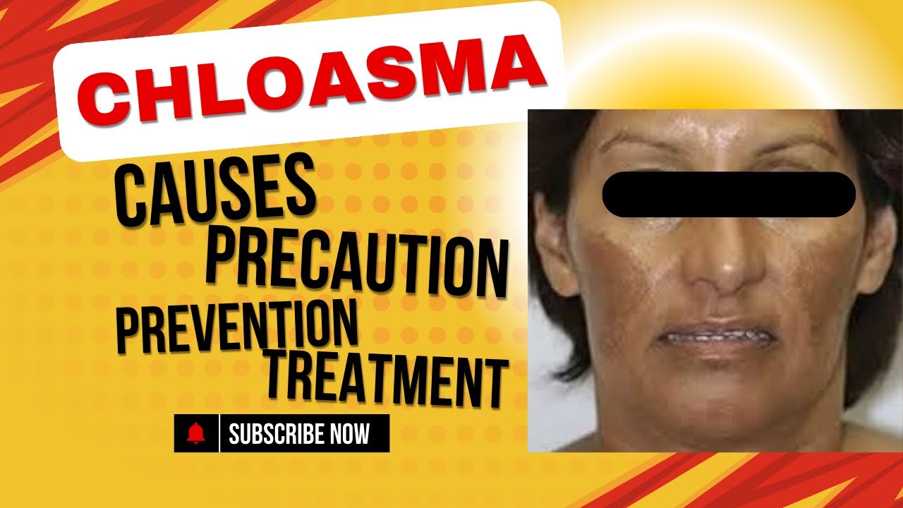 How to get rid of chloasma/ Melasma 