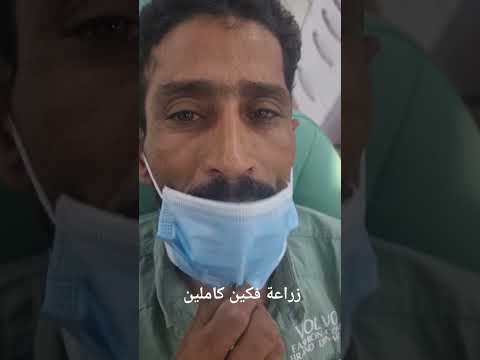 زراعة فكين كاملين   زراعة الاسنان