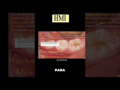 #hmi pt 1 #hipomineralizacionmolarincisivo #odontologia