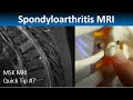 MRI in Axial Spondylarthritis: Thoracic Spine Inflammation (MSK MRI Quick Tip 7)