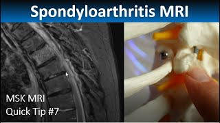 MRI in Axial Spondylarthritis: Thoracic Spine Inflammation (MSK MRI Quick Tip 7)