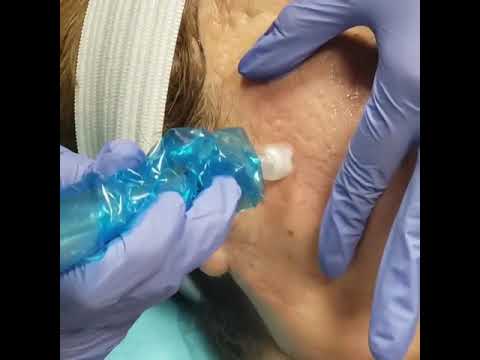 Exceed Microneedling treatment for acne scars