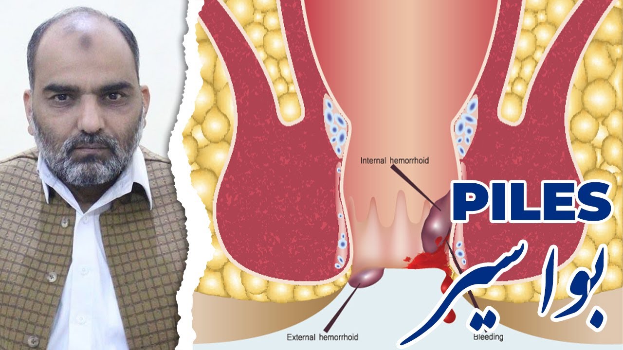 Bavaseer || Piles || By Dr. Rizwan Saqib || In Urdu/Hindi