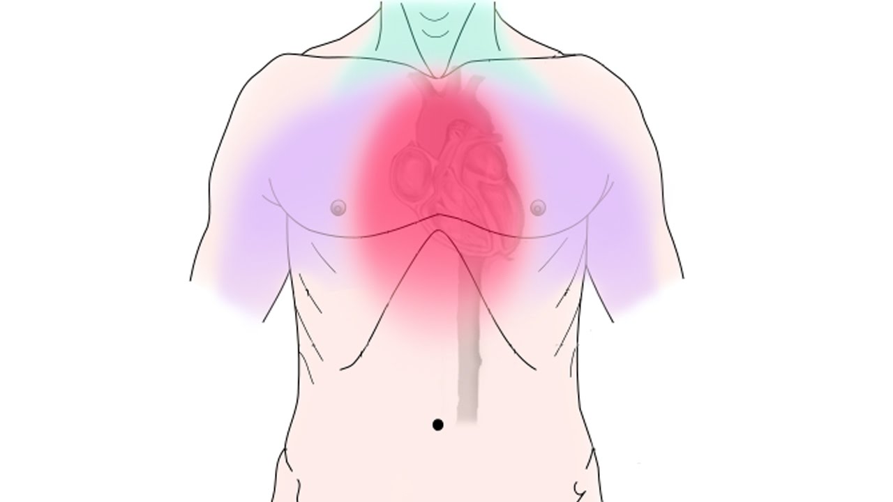 Сильная загрудинная боль. Неприятные ощущения за грудиной. Боли за грудиной рисунок.
