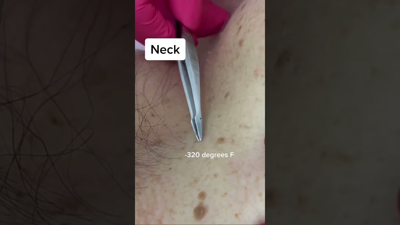 Skin Tag Removal Shorts