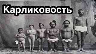 Карликовость.  Дварфизм. Причины, симптомы, формы, диагностика и лечение