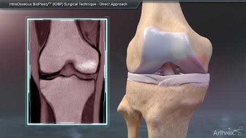 IntraOsseous BioPlasty™ (IOBP) Surgical Technique - Direct Approach