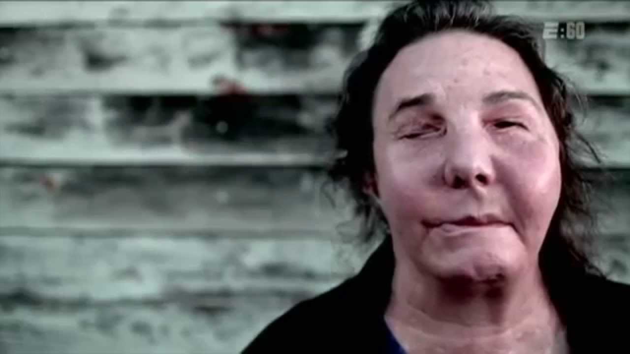 Resilience Carmen Blandin Tarleton’s Face Transplant Story YouTube