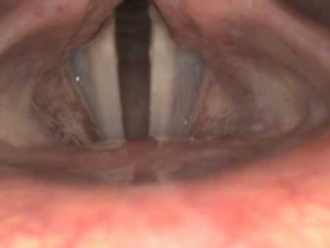 Laringostroboscopia.mpeg