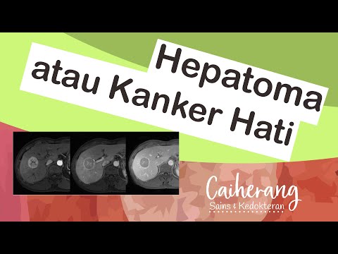 Mengenal Kanker Hati atau Hepatocellular Carcinoma (HCC) --- Deteksi dan Pengobatan Kanker Hati