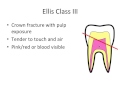 Tooth Trauma- Ellis Classification