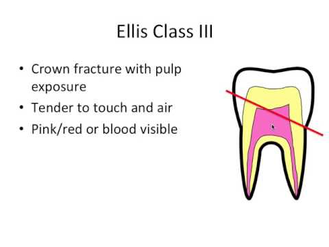 Tooth Fracture Classification