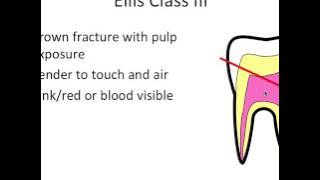 Tooth Trauma- Ellis Classification