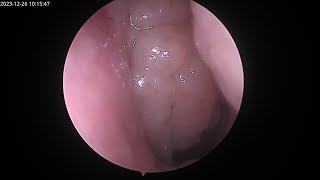 Endoscopic Adenoidectomy using Sinus Microdebrider.
