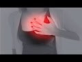 【閲覧注意】肺がんの7つのサイン。必ず知っておくべき!可能性がある人に表れる症状がコチラ!【衝撃】